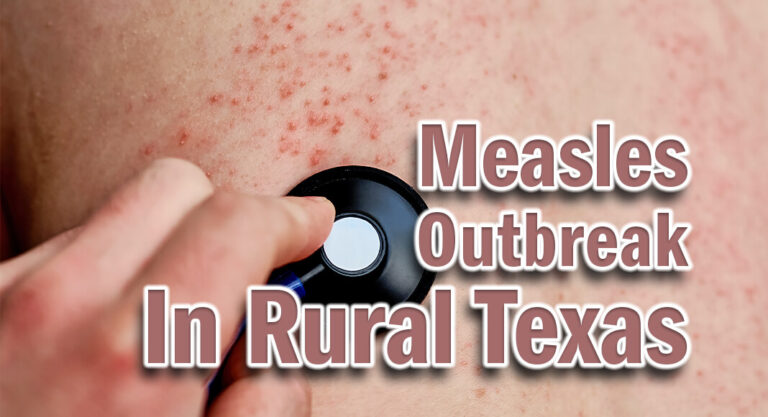 Measles Outbreak in Rural Texas